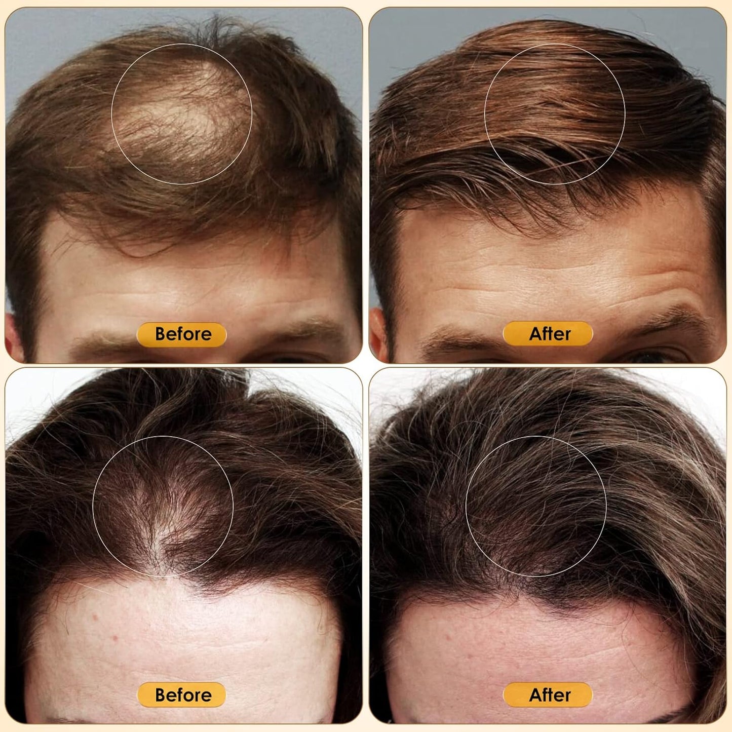 5% Minoxidil for Men & Women Hair Growth - Biotin Minoxidil Serum Oil for Beard Growth Stop Hair Thinning and Hair Loss For Stronger Thicker Longer Hair